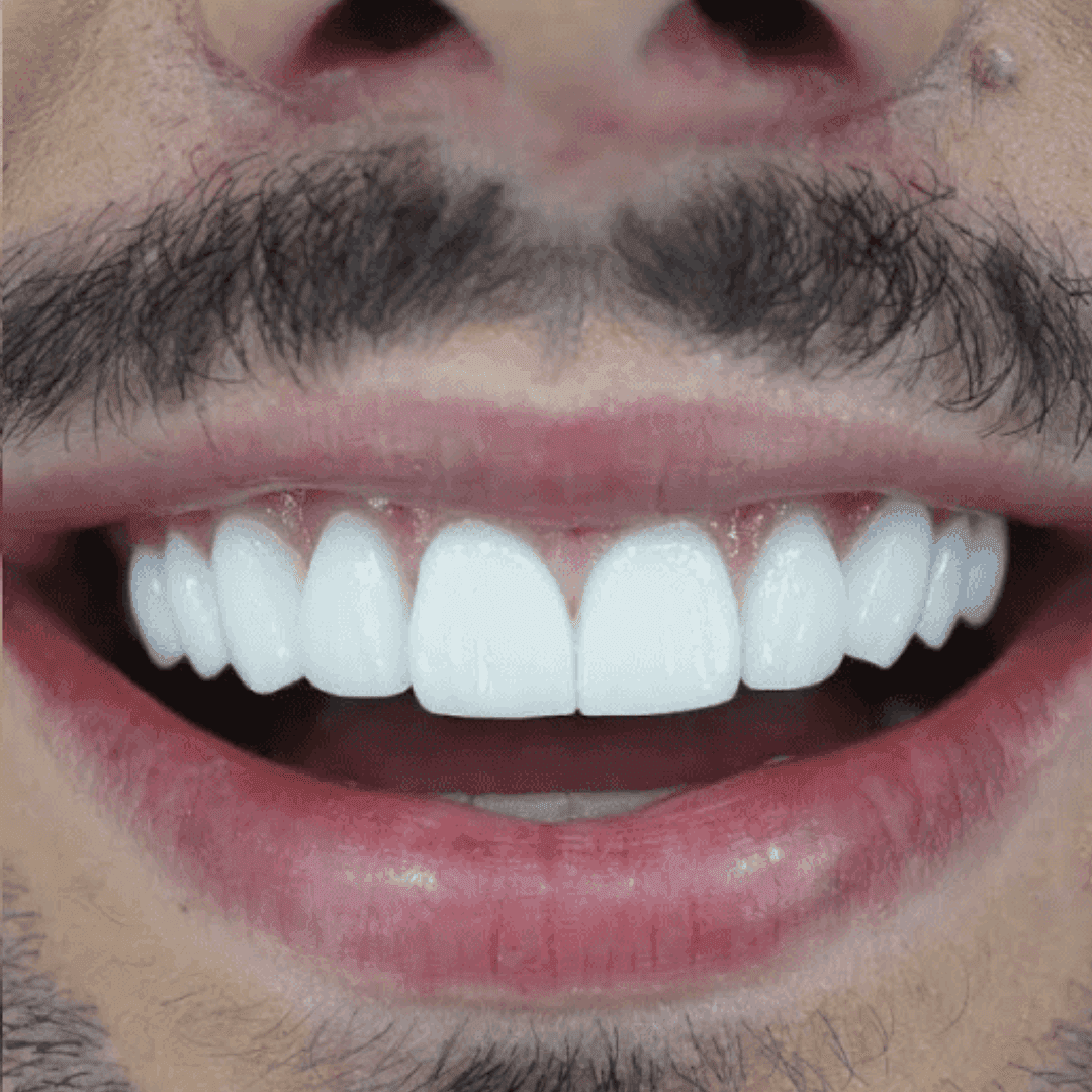 Depois do tratamento