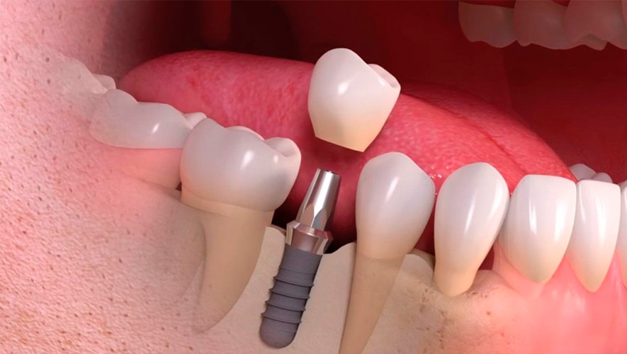 Implantes Dentários